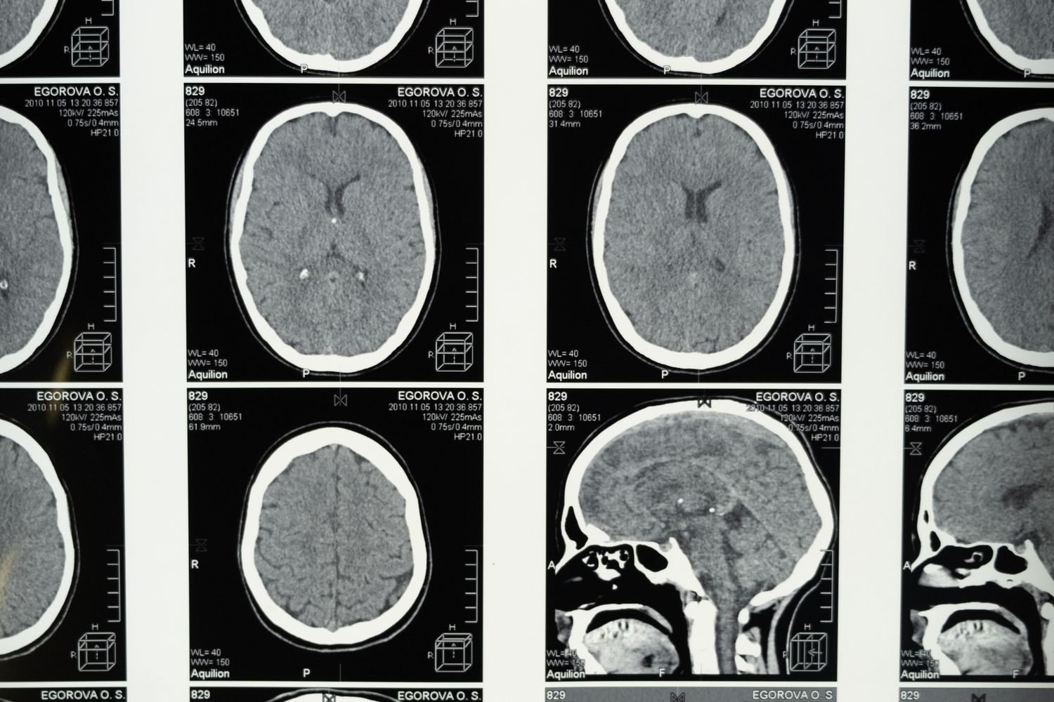 Illustration of glucose molecules fueling brain neurons for energy