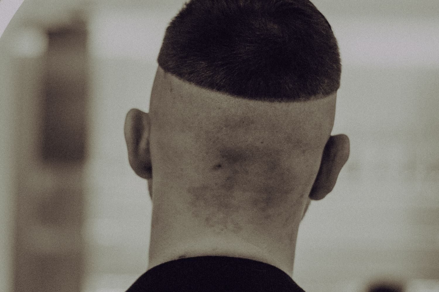 Comparison of diffuse shedding pattern in telogen effluvium versus receding hairline in pattern baldness